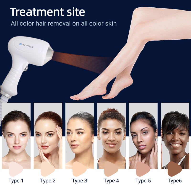 Portable Diode Laser Hair Removal